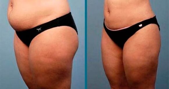 Methoden, um in einem Monat 10 Kilogramm Gewicht zu verlieren